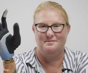 Hand that fused to bone and nerves