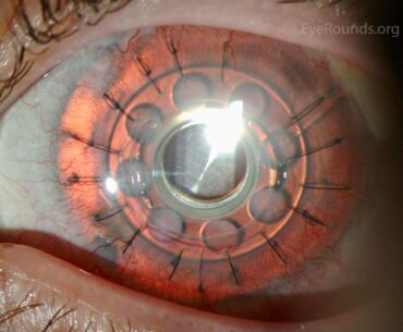 First Steps toward Augments
