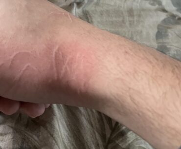 My cat scratched ix on my hand, could this be a black ops 4 reference