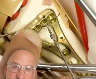 Fortified Ankles