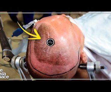 First human brain implant from NeuraLink