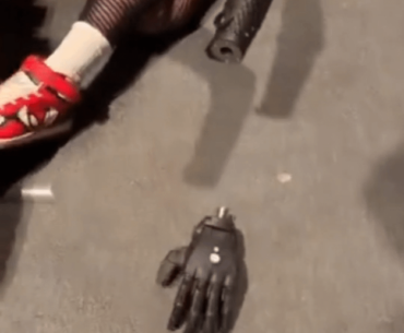 Double amputee testing out new prosthetic arms