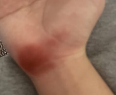 What should I do? Been happening a lot on my mouse hand.