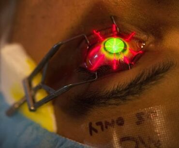 Corneal collagen cross-linking, a new procedure to prevent progression of keratoconus, a type of eye disease that gradually thins and bulges outward the cornea into a cone shape. UV light is directed into the eye together with riboflavin to form new cross-links between collagen fibers in the cornea