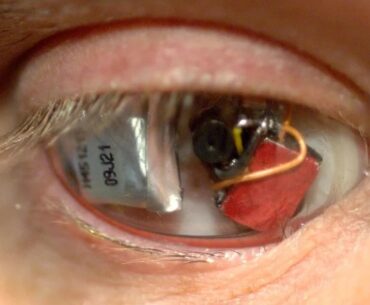 Prosthetic eye with wireless video camera embedded inside, worn by one-eyed filmmaker Rob Spence