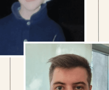 [OC] Real-life Cyberpunk: 30 years of 'hardware' upgrades. 19 surgeries later, finally a bionic ABI.
