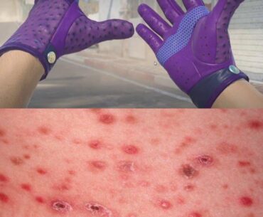 Driver Gloves | Acne Rash