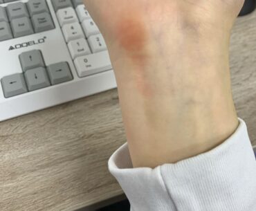 Does anyone else get this from using a mouse for too long?